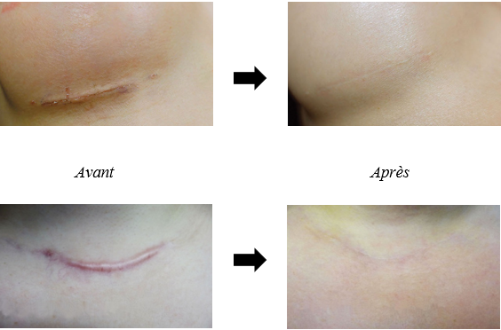 Ostéopathie et Cicatrices - Ostéopathe AYATI